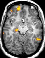 A functional MRI scan - the highlighted areas indicate brain activity